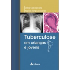 TUBERCULOSE EM CRIANCAS E JOVENS