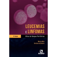 LEUCEMIAS E LINFOMAS