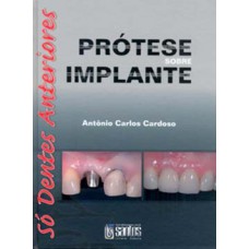 PRÓTESE SOBRE IMPLANTE: SÓ DENTES ANTERIORES